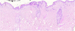 Placa temprana. Se observa un infiltrado linfoide atípico escaso perifolicular, con mucinosis folicular prominente, epidermotropismo con disposición lineal de los linfocitos en banda en la unión dermoepidérmica, llamando la atención el fondo fibrótico y con poiquiloderma, además de algunos queratinocitos apoptóticos y melanófagos.