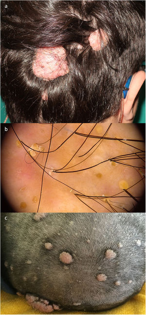 a) Hamartomas colágenos y folículo-quísticos en un paciente con complejo de esclerosis tuberosa; b) La dermatoscopia reflejó tapones amarillos en aberturas foliculares, descamación perifolicular, cabellos distróficos, aberturas foliculares vacías, eritema, y algunas vainas peripilares; c) Múltiples hamartomas en el cuero cabelludo del mismo paciente.