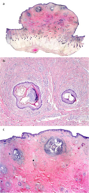 a) Histopatología del hamartoma; b) Fibrosis concéntrica circundante a los folículos pilosos (H&E, ×100); c) Histopatología que muestra la disposición irregular de los paquetes de colágeno espesos y los quistes foliculares rotos con inflamación supurativa (H&E, ×20).