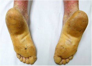 Diffuse waxy keratoderma on the soles.