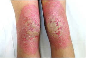 Erythematous scaly plaques on the knees.