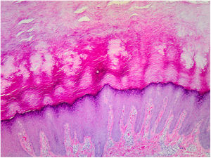 Histological image (hematoxylin–eosin, original magnification ×4). Orthokeratotic hyperkeratosis, acanthosis, and thickening of the granular layer.