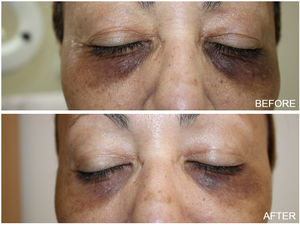 Paciente con ojeras antes del tratamiento y un mes después de la visita de seguimiento.