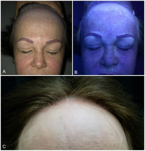 A and C, Recession of the frontal hairline with loss of follicular units, erythema, and perifollicular scale. Note the loss of eyebrow hair. Achromic macules following the same pattern. Lonely hair sign (black arrow). B, Wood lamp showing fluorescence.