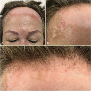 A–C, Evaluation at 6 months of treatment revealed evidence of repigmentation in some areas, reduced erythema, and growth of new hair follicles.
