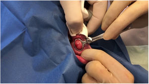 Resection of the lesion from the buccal mucosa.