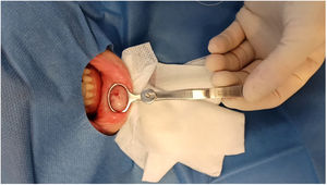 Biopsy of the labial mucosa in a patient with suspected cheilitis granulomatosa.