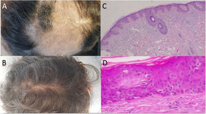 a: Gran zona de alopecia a lo largo de la región parietal-temporal-occipital, con escamas de color blanco a amarillento; b: Evidencia de rebrote de cabello tras la interrupción del tratamiento con secukinumab; c-d: Tinción hematoxilina-eosina: Dermatitis de interfase vacuolar asumida como farmacodermia debido al tratamiento biológico (c x4, d x100).