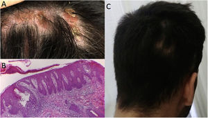 a: Placa inflamatoria alopécica con escamas hiperqueratósicas en el lugar en que emergían mechones de pelo; b: Dermatitis espongiótica que comprometía los folículos, semejante a un patrón psoriasiforme, apoptosis queratinocítica e hiperqueratosis folicular; c: Recuperación de cabello tras la interrupción de secukinumab.