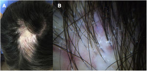 A, Patch of alopecia with irregular borders and inflammatory signs (erythema and scaling) on the periphery. B, Trichoscopy reveals perifollicular scaling and erythema, with no pustules or crusts.
