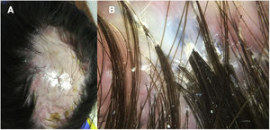 A, Progression of the patch of cicatricial alopecia, with yellowish crusts and inflammatory signs at the edges of the patch. B, Trichoscopy reveals follicular tufts.