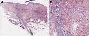 A, Perifollicular inflammatory infiltrate, with no lesions in the epidermis (hematoxylin–eosin, ×4). B, The inflammatory infiltrate is formed mainly by lymphocytes, with scant plasma cells and no interface lesion (hematoxylin–eosin, ×10).