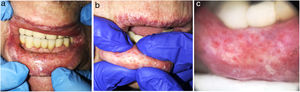 Clinical manifestations. A, Multiple, regularly distributed, and tiny monomorphic erythematous spots on the mucosa of the lower lip. B, Drainage of transparent gelatinous material through the ostia with gentle pressure. C, Dermoscopy showing round, cup-shaped structures with a more erythematous center, and a double vascular pattern comprising fine peripheral hairpin vessels and rosary bead–shaped vessels arranged in the shape of a fingerprint.