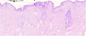 Early-stage plaque. Scarce perifollicular atypical lymphoid infiltrate can be observed, with prominent follicular mucinosis, epidermotropism with linear bands of lymphocytes at the dermal–epidermal junction. Of note is the fibrotic background and poikiloderma, as well as some apoptotic keratinocytes and melanophages.