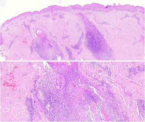 Advanced plaque. A dense atypical follicular lymphoid infiltrate is seen with follicular destruction (as observed in the magnified image), with prominent interfollicular and perivascular involvement, and limited epidermal involvement.