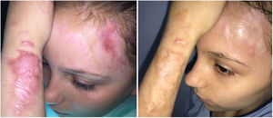 Example of treatment with 595-nm pulsed dye laser (4 sessions), before (left) and after (right).
