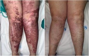 Example of treatment with a 595-nm pulsed dye laser (8 sessions), fractional carbon dioxide laser (7 sessions), and a 755-nm alexandrite laser (3 sessions), before (left) and after (right).