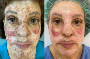Example of treatment with a 595-nm pulsed dye laser (2 sessions), fractional carbon dioxide laser (1 session), and 755-nm alexandrite laser (2 sessions), before (left) and after (right).
