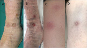 A, Deep ulcers with an erythematous border and a fibrinous base that persisted despite treatment with nonsteroidal anti-inflammatory drugs, oral corticosteroids, and local dressings. B, Reduction in the diameter and depth of ulcers after 2 cycles of pembrolizumab. C, Linear, erythematous, subcutaneous nodules in the lower limbs. D, Complete resolution of nodules with mild postinflammatory hyperpigmentation after 2 cycles of pembrolizumab.