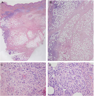 Histologic image (hematoxylin–eosin, original magnification ×20) showing extensive involvement of the dermis and the septa and lobules of the subcutaneous fatty tissue (A), extensive necrosis in these locations (B), signs of vasculitis (C), and scant associated granulomas (D).