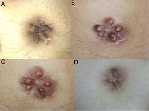 A, Lesions before pregnancy. B, Lesions at week 24 of pregnancy. C, Lesions at week 35 of pregnancy. D, Lesions 3 months after delivery.