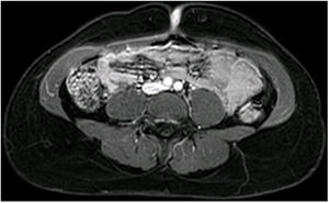 Magnetic resonance image. Oval umbilical skin lesion showing intense contrast uptake in contact with the abdominal muscles.