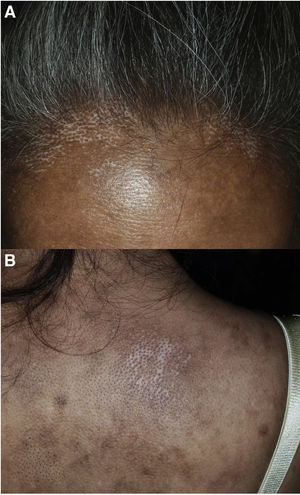 Dot-like perifollicular dyschromia: the salt and pepper sign. A, At the edge of the frontal hairline in a 62-year-old patient initially diagnosed with vitiligo repigmentation. B, On the right scapula in a 42-year-old patient initially diagnosed with friction melanosis.