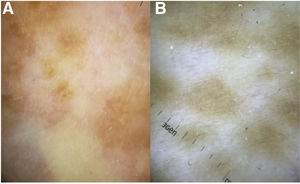 Dermoscopic features of perifollicular repigmentation in stable vitiligo. A, Structureless white areas, diffuse pigment network, and perifollicular erythema. B, Perifollicular repigmentation in a pigment network with ill-defined borders.