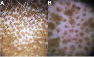 Dermoscopic features of dyschromia in salt and pepper skin. A, Accentuated pigment network surrounding a whitish perifollicular circle against an achromic background. B, Accentuated pigment network surrounding a uniform whitish perifollicular halo against white areas with telangiectasias.