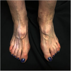 Hypopigmented patch, skin atrophy, and muscle atrophy on the dorsum of the right foot.