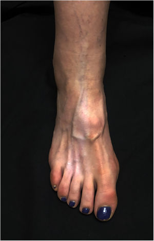 Triangular, linear hypopigmentation with well-defined borders following the distribution of the lymphatic channels between the second and fourth metatarsals and the ankle.