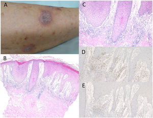 A)Placas queratósicas violáceas diseminadas en la parte baja de la pierna. B)Las características histológicas revelaron proliferación epidérmica irregular con edema subepidérmico e infiltrados celulares en la dermis superior. Tinción hematoxilina-eosina (HE), ×100. C)Ampliación máxima que muestra degeneración de la licuefacción de las capas epidérmicas basales. HE, ×200. Las células infiltrantes fueron inmunorreactivas para CD4, ×200 (D) y CD8, ×200 (E). gr1.