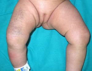 Purple macules in the groin area and on the right leg.