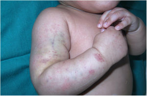 Bruising in pressure-bearing areas.