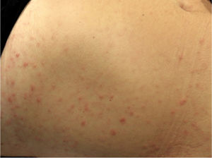Erupción papular en el abdomen.