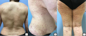 a. Pápulas eritematosas en la espalda con estructuras costrosas hemorrágicas en el centro. b. Pápulas y placas liquenificadas de tonalidad de eritematosa a púrpura en el aspecto lateral del tronco. c. Pápulas y placas de tonalidad de eritematosa a púrpura en la pierna.