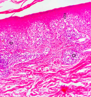 En la epidermis existe alteración vacuolar de la capa basal y exocitosis de linfocitos (flecha). En la dermis superficial existe infiltrado en forma de banda (estrella bajo la epidermis) perivascular (la otra estrella) compuesto de linfocitos (HE, ×200).