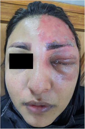 lesiones cutáneas papulopustulares vesiculares en el lado izquierdo del rostro, sin cruzar la línea media.