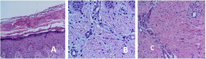 A) Acantosis epidérmica. Vesícula subcorneal con contenido de eosinófilos. B) Acantosis epidérmica. Dermis con eosinófilos. C) Infiltrado inflamatorio dérmico perivascular con eosinófilos.