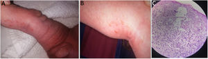 A y B) Lesiones verrucosas (estadio 2) siguiendo las líneas de Blaschko. C) Epidermis: espongiosis con formación de vesículas espongióticas intradérmicas y exocitosis de numerosos eosinófilos. Células disqueratósicas con citoplasma hialino. Dermis con edema e infiltrado inflamatorio superficial mononuclear con eosinófilos y melanófagos.