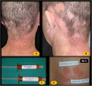 A y B. Erupción eccematosa en el cuello. C. Minoxidil al 1 y 5% en DMSO preparado por nuestro Servicio de Farmacia Hospitalaria. D. Prueba de parche negativa en el día 2 de minoxidil al 1 y 5% en DMSO. E. Prueba de parche positiva en el día 4 de minoxidil al 1 y 5% en DMSO.