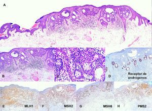 Acantoma reticulado con diferenciación sebácea. A) Microfotografía (H-E 4X). Lesión neoplásica de aspecto epitelial anexial caracterizada por una proliferación de queratinocitos eosinofílicos predominantes. B) Microfotografía (H-E 10X). Pequeños focos de aspecto más basaloides anastomosados. C) Microfotografía (H-E 40X). Presencia de grupos de sebocitos en la base de los cordones epiteliales anastomosados. D) Microfotografía (10X). Inmunohistoquímica para receptores de andrógenos en la que resalta el componente sebáceo. E) Microfotografía (10X). Inmunohistoquímica para MLH1 con patrón nuclear intacto. F) Microfotografía (10X). Inmunohistoquímica para MSH2 con patrón nuclear intacto. G) Microfotografía (10X). Inmunohistoquímica para MSH6 conpatrón nuclear intacto. H) Microfotografía (10X). Inmunohistoquímica para PMS2 con patrón nuclear intacto.