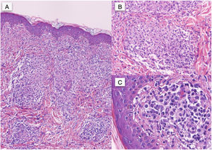Hematoxylin-eosin staining. Original magnification ×40 (A), ×200 (B), and ×400 (C).