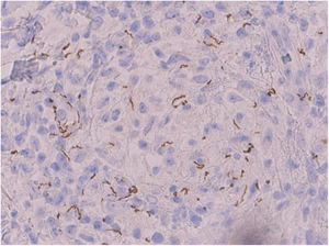 Immunohistochemical staining. Treponemal antibodies, original magnification ×400.