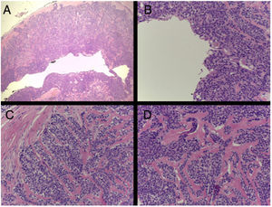 A, Hematoxylin–eosin, original magnification ×20. B–D, Hematoxylin–eosin, original magnification ×200.