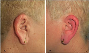 (A) Erythema and swelling of the left external ear. (B) Unaffected right ear.