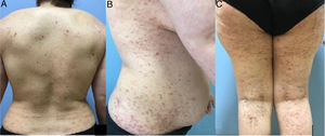 A, Erythematous papules on the back with hemorrhagic crusted structures in the center. B, Lichenified erythematous-purple papules and plaques on the lateral aspect of the trunk. C, Erythematous-purple papules and plaques on the leg.