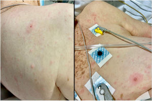 Polymorphous eruption consisting of macules, papules, and some vesicles on the patient