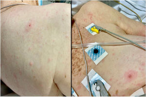 Polymorphous eruption consisting of macules, papules, and some vesicles on the patient's arrival at the emergency department.