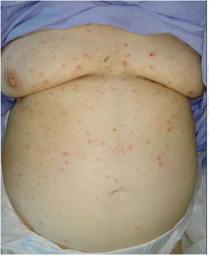 At 48h, most of the rash was in the blister phase.